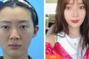 秦皇島紀(jì)輝整形美容醫(yī)院江川整形價(jià)格表附埋線提升案例展示