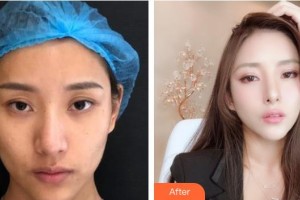 秦皇島紀(jì)輝整形美容醫(yī)院鄭杰整形價(jià)格表附埋線提升案例展示