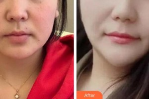 秦皇島友誼醫(yī)院整形美容外科訾海濤整形價(jià)格表附埋線提升案例展示