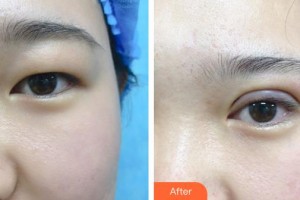 秦皇島紀(jì)輝整形美容醫(yī)院王雷整形價(jià)格表附眼部綜合案例展示