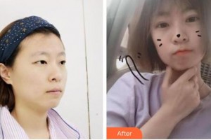 秦皇島念奴嬌醫(yī)療美容門診部康凱整形價(jià)格表附切開雙眼皮案例展示