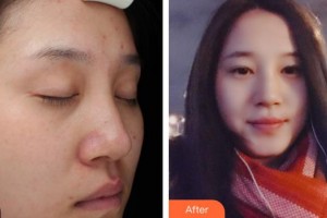 秦皇島巧致美容醫(yī)院咸福實(shí)整形價格表附祛斑祛痣案例展示