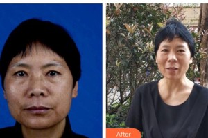 秦皇島巧致美容醫(yī)院張凱華整形價(jià)格表附微針美膚案例展示