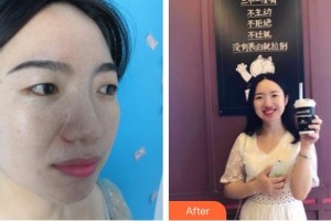 秦皇島釹娃（原女娃）醫(yī)療美容診所張曉陽(yáng)整形價(jià)格表附光子嫩膚案例展示