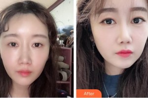 秦皇島東方皮膚醫(yī)學(xué)門診部王彩霞整形價(jià)格表附去痘印痘坑案例展示