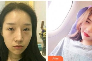 秦皇島慈善醫(yī)院整形美容科岳紅利整形價(jià)格表附肋軟骨隆鼻案例展示