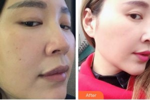 秦皇島愛爾眼科醫(yī)院王東英整形價(jià)格表附鼻部綜合案例展示