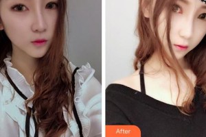 秦皇島愛爾眼科醫(yī)院張一凡整形價(jià)格表附埋線雙眼皮案例展示