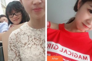 秦皇島愛爾眼科醫(yī)院張巖整形價(jià)格表附切開雙眼皮案例展示