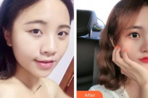 秦皇島愛爾眼科醫(yī)院薛巖整形價(jià)格表附眼部綜合案例展示