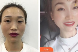 秦皇島愛爾眼科醫(yī)院白玉星整形價(jià)格表附眼部綜合案例展示