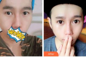 秦皇島愛爾眼科醫(yī)院劉秀整形價(jià)格表附切開雙眼皮案例展示