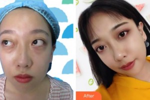 秦皇島巧致整形醫(yī)院周海燕整形價(jià)格表附內(nèi)切祛眼袋案例展示