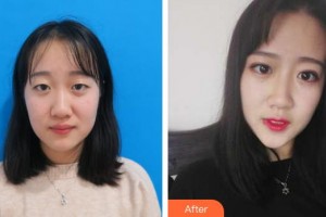 秦皇島巧致整形醫(yī)院楊哲整形價(jià)格表附切開雙眼皮例展示