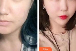 秦皇島東方皮膚醫(yī)學(xué)門診部馬嚴(yán)整形價(jià)格表附埋線提升案例展示