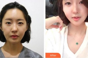 唐山光明醫(yī)院尹亞玲整形價格表附微針美膚案例展示