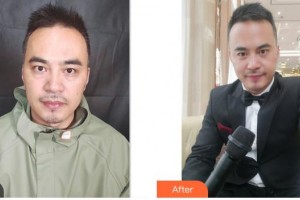 唐山冀東眼科醫(yī)院劉淑偉整形價格表附內(nèi)切祛眼袋案例展示