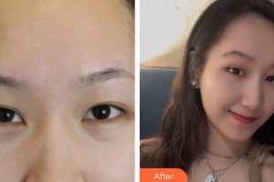 唐山冀東眼科醫(yī)院于秋菊整形價格表附切眉術(shù)案例展示