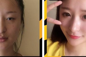 唐山冀東眼科醫(yī)院李玉濤整形價格表附埋線雙眼皮案例展示