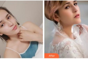 唐山冀東眼科醫(yī)院張成整形價格表附切開雙眼皮案例展示