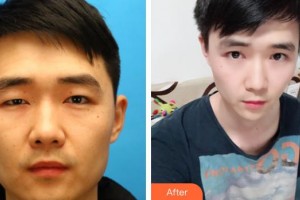 唐山冀東眼科醫(yī)院薛愛君整形價格表附切開雙眼皮案例展示