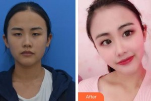 唐山光明醫(yī)院高斌儒整形價格表附定點(diǎn)雙眼皮案例展示