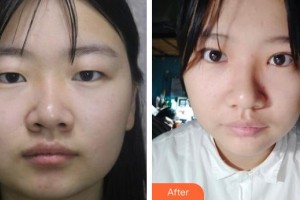 唐山冀東眼科醫(yī)院劉若屏整形價格表附眼部綜合案例展示