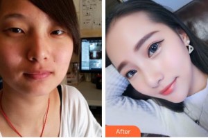 唐山冀東眼科醫(yī)院陳惠茹整形價格表附定點(diǎn)雙眼皮案例展示