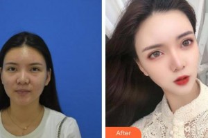 唐山星光醫(yī)療美容門診部彭于賓整形價格表附激光去眼袋案例展示