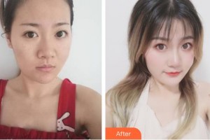 唐山星光醫(yī)療美容門診部劉俊偉整形價格表附去痘印痘坑案例展示