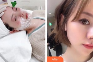 邯鄲雅乾醫(yī)療美容診所劉紅艷整形價(jià)格表附熱瑪吉案例展示