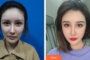 邯鄲都市整形美容醫(yī)院朱洪濤整形價(jià)格表附埋線提升案例展示