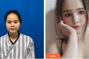 邯鄲現(xiàn)代麗人醫(yī)院整形美容中心李靈玲整形價格表附肋軟骨隆鼻案例展示