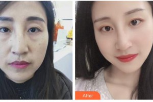 邯鄲雅麗醫(yī)療美容門診部張子建整形價格表附埋線提升案例展示