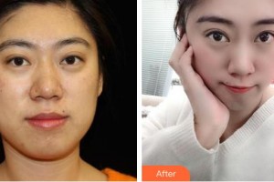 邢臺美在人生（原美聯(lián)臣）醫(yī)療美容診所王桂華整形價格表附埋線提升案例展示