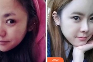 邢臺(tái)美在人生（原美聯(lián)臣）醫(yī)療美容診所王寶薔整形價(jià)格表附埋線提升案例展示