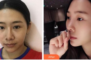 邢臺(tái)廣慈整形美容醫(yī)院焦理強(qiáng)整形價(jià)格表附眼部綜合案例展示