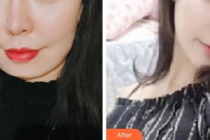 邢臺(tái)美加美醫(yī)療美容診所陳譽(yù)華整形價(jià)格表附切開雙眼皮案例展示