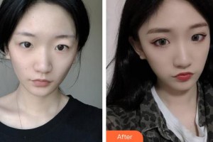 保定市第二醫(yī)院美容科董敏整形價(jià)格表附埋線提升例展示