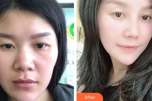 保定華仁皮膚病醫(yī)院激光美容中心霍孟華整形價(jià)格表附埋線提升案例展示