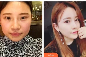 保定世紀(jì)協(xié)和醫(yī)院整形美容中心周軍臣整形價(jià)格表附熱拉提案例展示