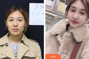 保定珍潤醫(yī)療美容門診部何棟良整形價(jià)格表附肋軟骨隆鼻案例展示