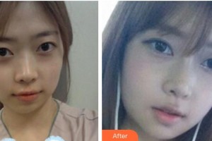 保定藍(lán)山醫(yī)療美容醫(yī)院杜建龍整形價(jià)格表附假體隆鼻案例展示