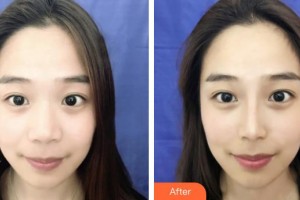 保定藍(lán)山醫(yī)療美容醫(yī)院劉海濤整形價(jià)格表附鼻部綜合案例展示