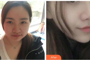 保定杏林中醫(yī)醫(yī)院整形外科從相文整形價(jià)格表附耳軟骨復(fù)合隆鼻案例展示