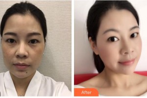 保定華仁皮膚病醫(yī)院激光美容中心馬雪娟整形價(jià)格表附埋線提升案例展示