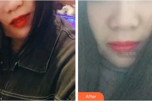 保定華美整形美容醫(yī)院魏繼鵬整形價(jià)格表附超聲波潔牙案例展示