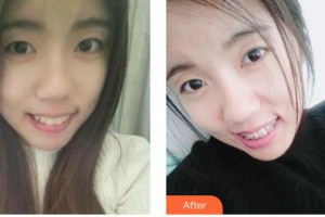 保定珍潤(rùn)醫(yī)療美容門診部王博謙整形價(jià)格表附眼部綜合案例展示