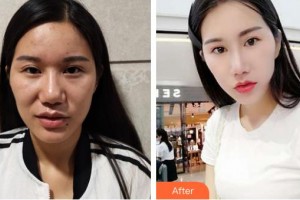 保定藍(lán)山醫(yī)療美容醫(yī)院于慧整形價(jià)格表附切開雙眼皮案例展示