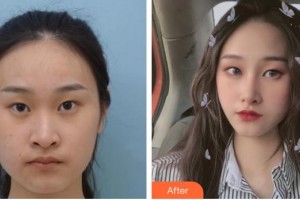 保定珍潤(rùn)醫(yī)療美容門診部戚容整形價(jià)格表附切開雙眼皮案例展示